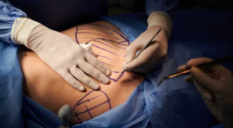 Cirurgia Reparadora de Mama São Pedro - Cirurgia Plástica