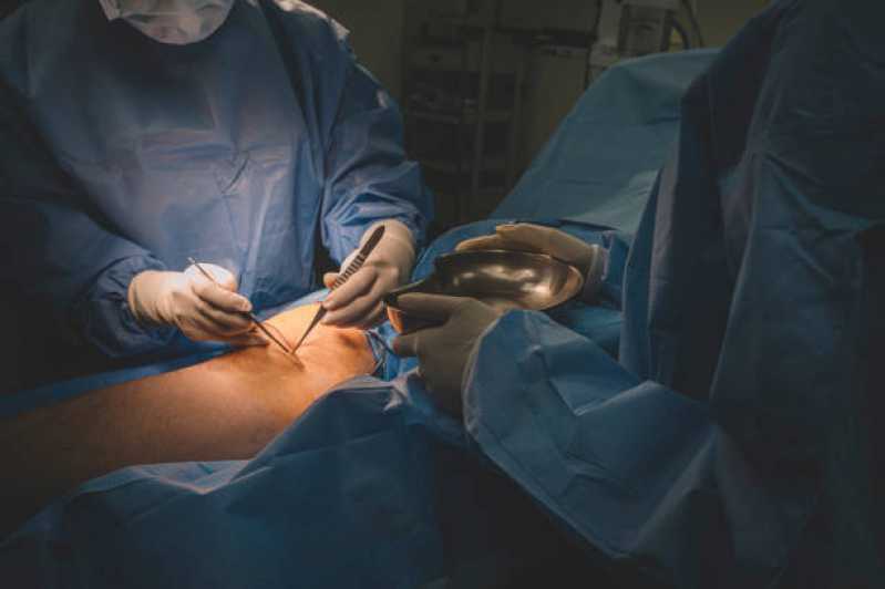 Cirurgia Vascular a Laser Agendar Jardim Dom Bosco - Cirurgia para Varizes