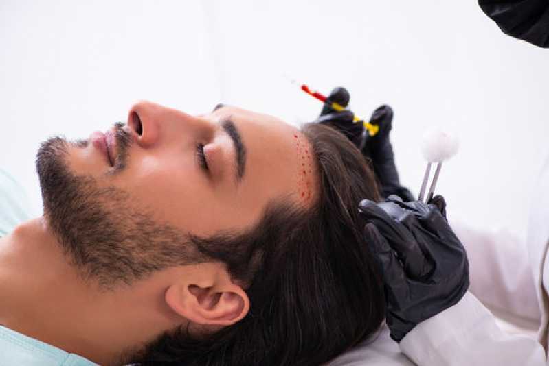 implante de cabelo masculino clínica Swiss Park