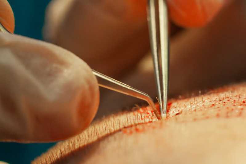 Clínica de Implante de Cabelo Telefone Campo dos Amarais - Clínica de Transplante de Cabelo Valinhos