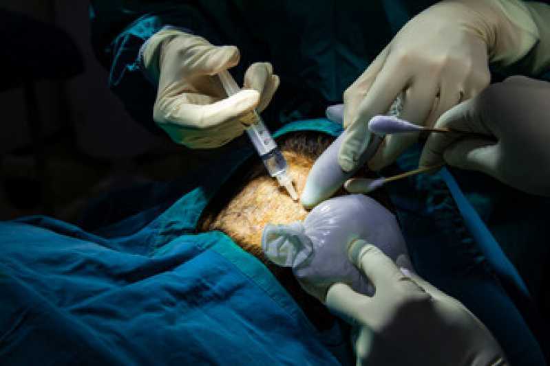 Clínica de Transplante de Cabelo Loteamento Center Santa Genebra - Clínica Implante Capilar