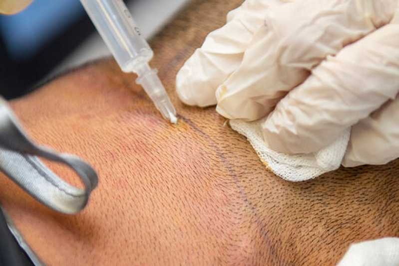 Clínica para Tratamento de Cabelo Vila Itapura - Clínica de Transplante de Cabelo