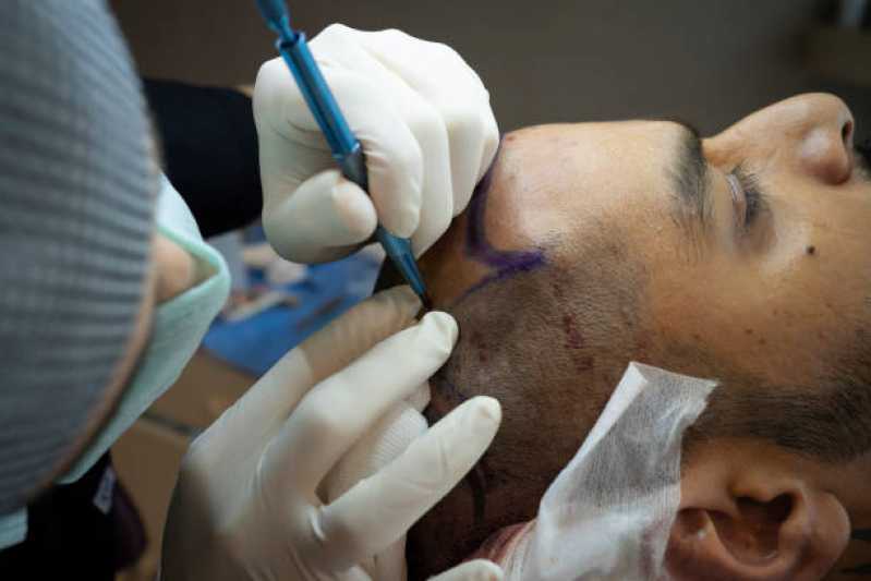 Clínica Que Faz Implante Cabelo Masculino Vila Santana - Implante de Cabelo para Homens