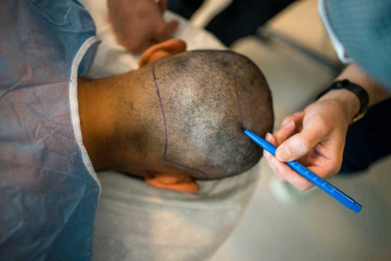 Clínica Que Faz Implante Cabelo Guanabara - Implante de Cabelo para Homens