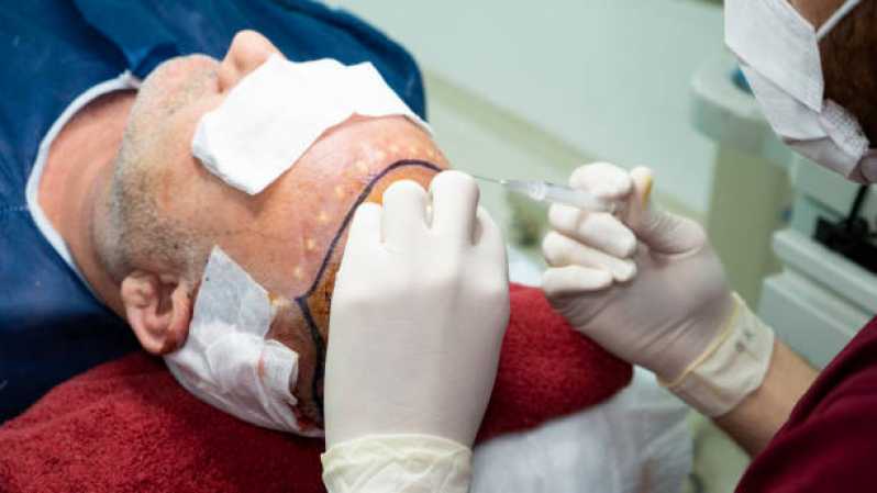 Clínica Que Faz Implante de Cabelo Masculino Sousas Park - Implante de Cabelo