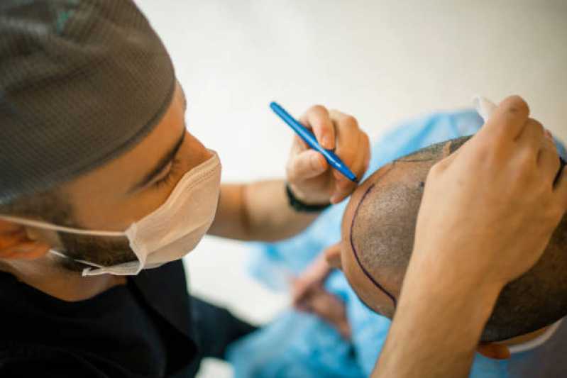 Clínica Que Faz Implante de Cabelo Mulher Vila São Joaquim - Implante de Cabelo para Homens