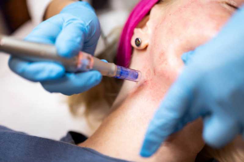 Dermatologia Oncológica Marcar São Pedro - Dermato Especialista em Cabelo Valinhos