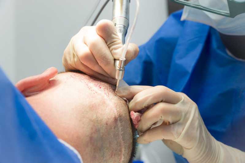 Endereço de Clínica Especializada em Queda de Cabelo Mogi Mirim - Clínica de Implante de Cabelo