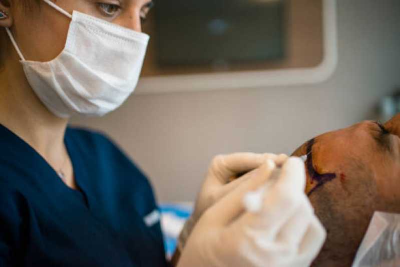Implante Cabelo Vila Nova - Implante de Cabelo para Homens