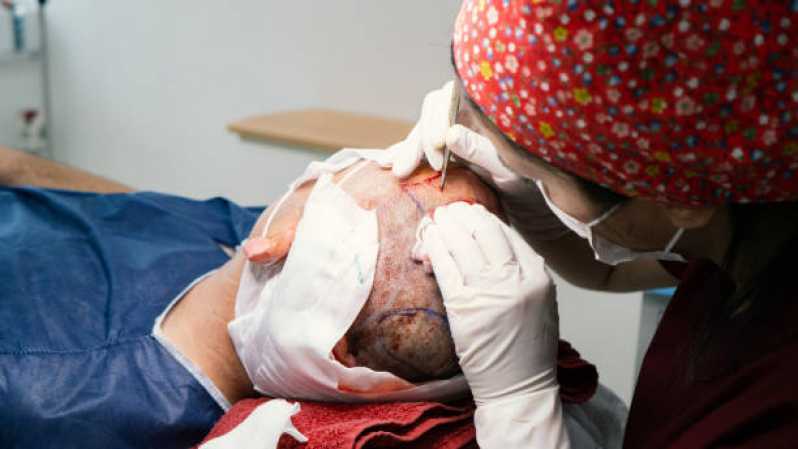 Implante Capilar na Testa Vila 31 de Março - Implante Capilar para Mulheres Homens