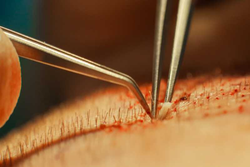 Implante Capilar para Diminuir a Testa Pedreira - Implante Fio a Fio Campinas