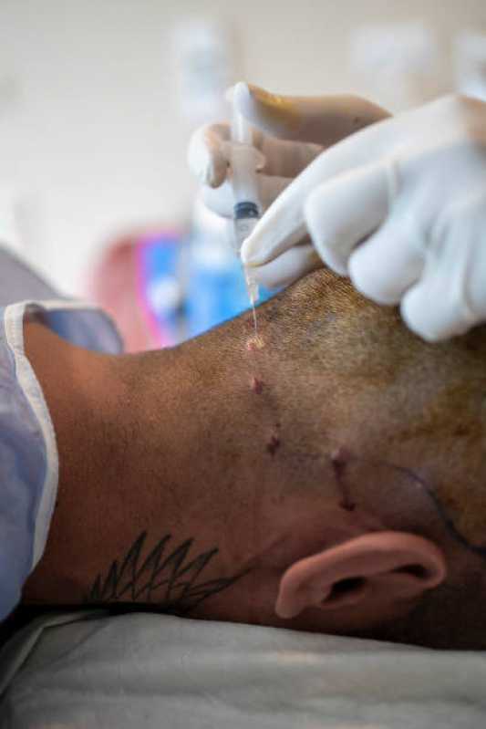 Implante de Cabelo Mulher Clínica Guanabara - Implante de Cabelo Campinas