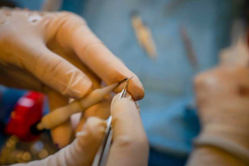 Onde Fazer Implante Capilar Feminino Guanabara - Implante Capilar para Mulheres Homens