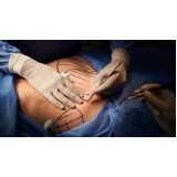 cirurgia reparadora de mama Loteamento Center Santa Genebra