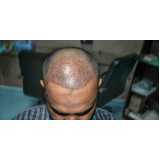 clínica de transplante de cabelo masculino Entreverdes