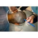 clínica que faz implante cabelo Jardim Nossa Senhora Auxiliadora