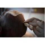 clínica que faz implante de cabelo cacheado Fazenda das Cabras