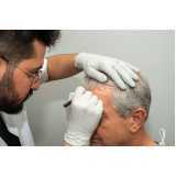 clínica que faz implante de cabelo fia a fio Parque Jatibaia