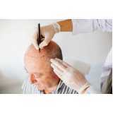 clínica que faz implante de cabelo Colinas do Ermitage