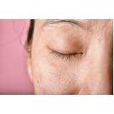 consulta de dermatologia para acne Mogi Mirim