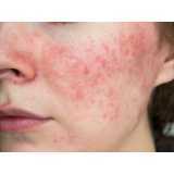 dermatologia para acne marcar Parque Imperador