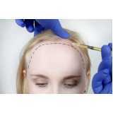 endereço de clínica de transplante capilar feminino na testa Vale das Garças (Correios: Loteamento Chácara