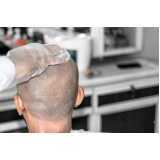 endereço de clínica para tratamento queda de cabelo Sitio dos Cambáras