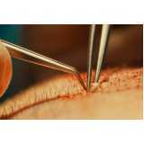 implante capilar feminino clínica Socorro