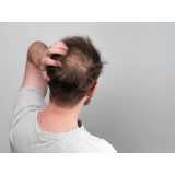 onde fazer tratamento para queda de cabelo masculino Iracemápolis