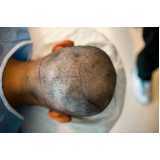 transplante de cabelo fia a fio clínica Sousas Park