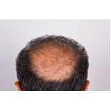tratamento de queda de cabelo clínica Fazenda Iracema