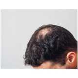 tratamento para queda de cabelo masculino clínica Vila 31 de Março
