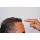 tratamento queda de cabelo masculino clínica Loteamento Caminhos de San Conrado