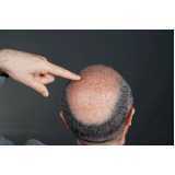tratamento queda de cabelo masculino Vila 31 de Março