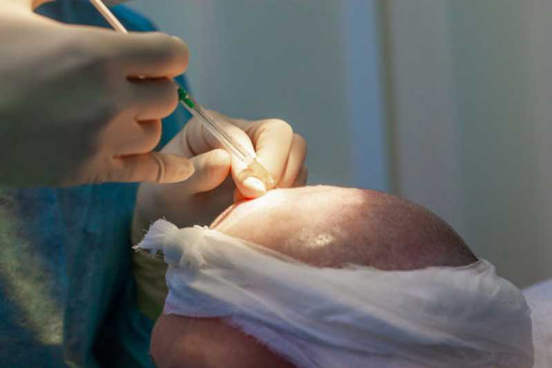 Transplante Cabelo Masculino Clínica Vila Industrial - Transplante de Cabelo para Mulheres