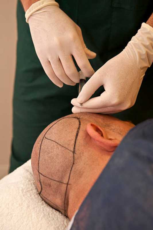 Tratamento Antiqueda Clínica Holambra - Tratamento para Queda de Cabelo Masculino