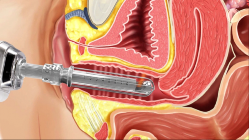 Tratamento de Estética íntima com Laser Fotona Cordeirópolis - Tratamento de Estética íntima Clareamento